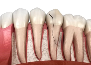 دندان ترک خورده - روکش یا درمان ریشه یا روکش؟