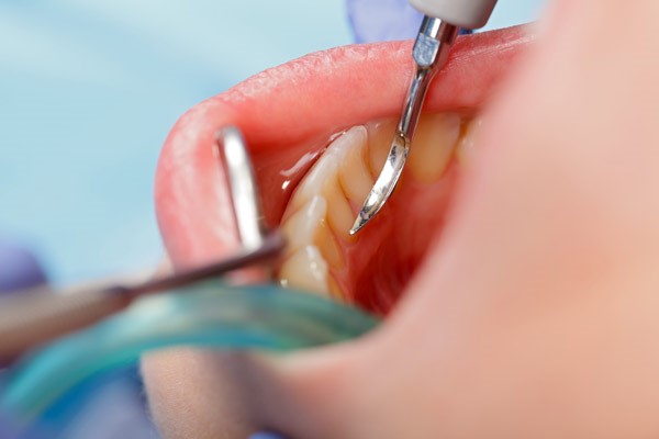 1 2 - جرم گیری دندان