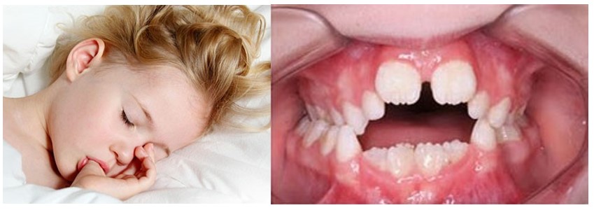 فاصله‌ی بین دندان‌ها