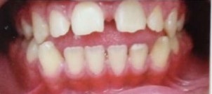 فاصله‌ی بین دندان‌ها