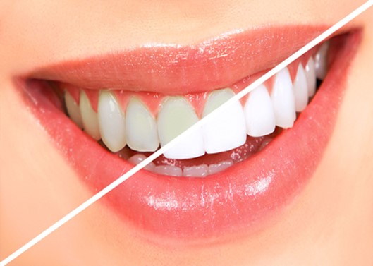 0 1 - فواید و معایب بلیچینگ یا سفید کردن دندان‌ها