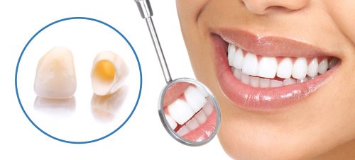 0 - مراحل آماده سازی روکش دندان و مراقبت از آن