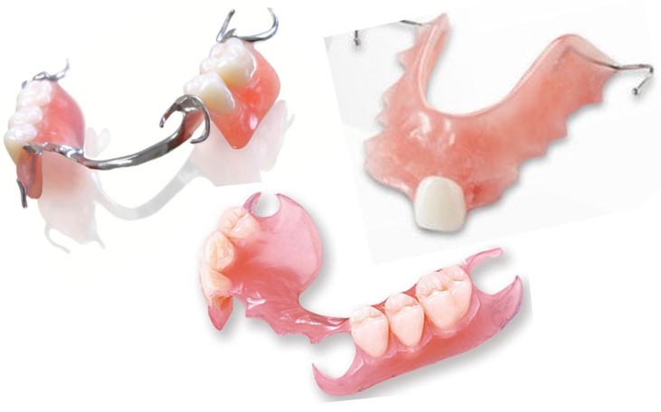قیمت انواع دندان مصنوعی (پروتز یا دنچر)