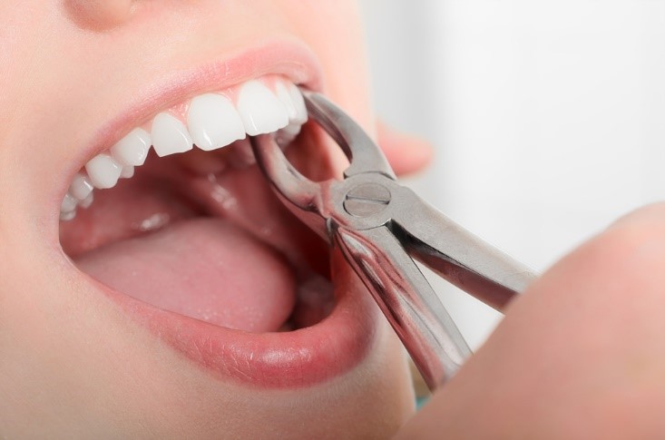 0 4 - کشیدن دندان