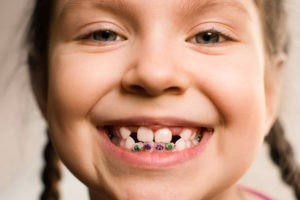 0 1 - رشد نکردن دندان دائمی در کودکان