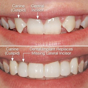 رشد نکردن دندان دائمی در کودکان