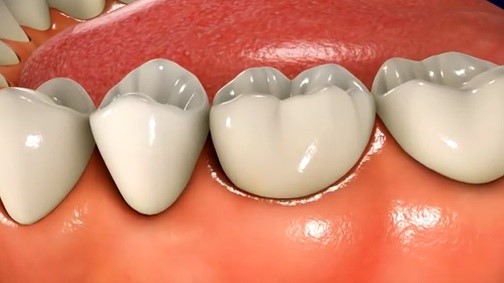حساسیت دندان ها