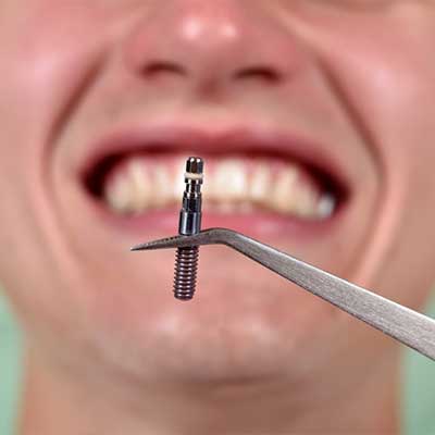 1 3 - دلایل شکست ایمپلنت های دندانی