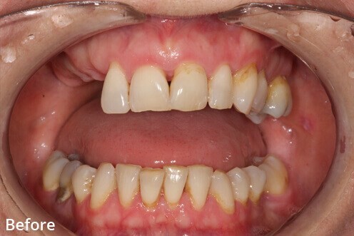 ایمپلنت های دندانی