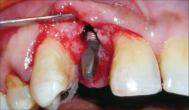 دلایل شکست ایمپلنت های دندانی