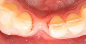 پیوند استخوان قبل از کاشت ایمپلنت های دندانی