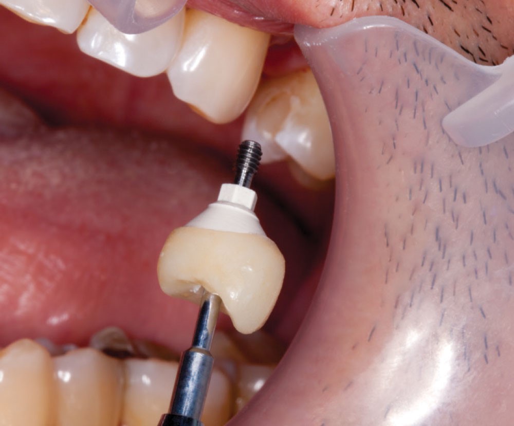 روکش های پیچ شونده و چسب شونده ایمپلنت دندانی – بخش اول