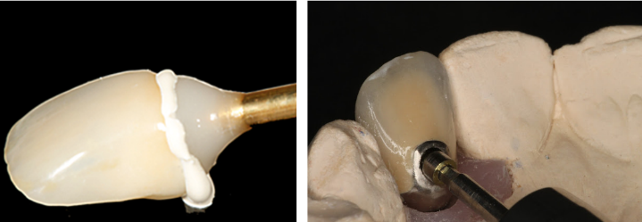 روکش های پیچ شونده و چسب شونده ایمپلنت دندانی – بخش اول
