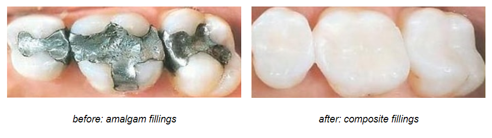 کامپوزیت های دندانی