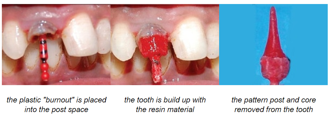 پست و کور برای ترمیم و اصلاح دندان