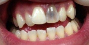 از دست رفتن دندان