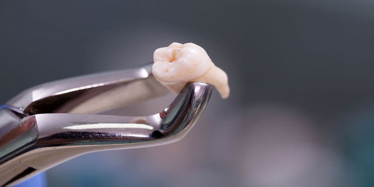 26 - چه زمانی کشیدن دندان با جراحی ضروری است؟