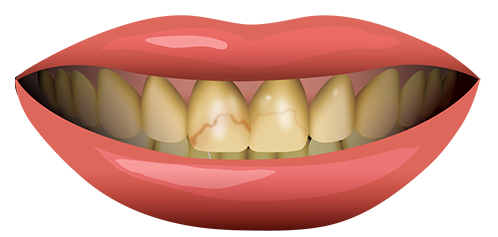 لکه دندان و درمان آن