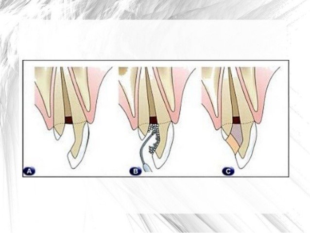 بلیچینگ داخلی دندان یا سفید کردن داخلی دندان