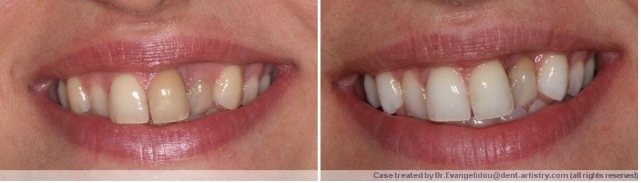 بلیچینگ داخلی دندان یا سفید کردن داخلی دندان
