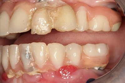 عفونت ایمپلنت های دندانی