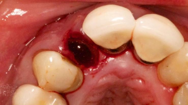 مشکلات پس از کشیدن دندان