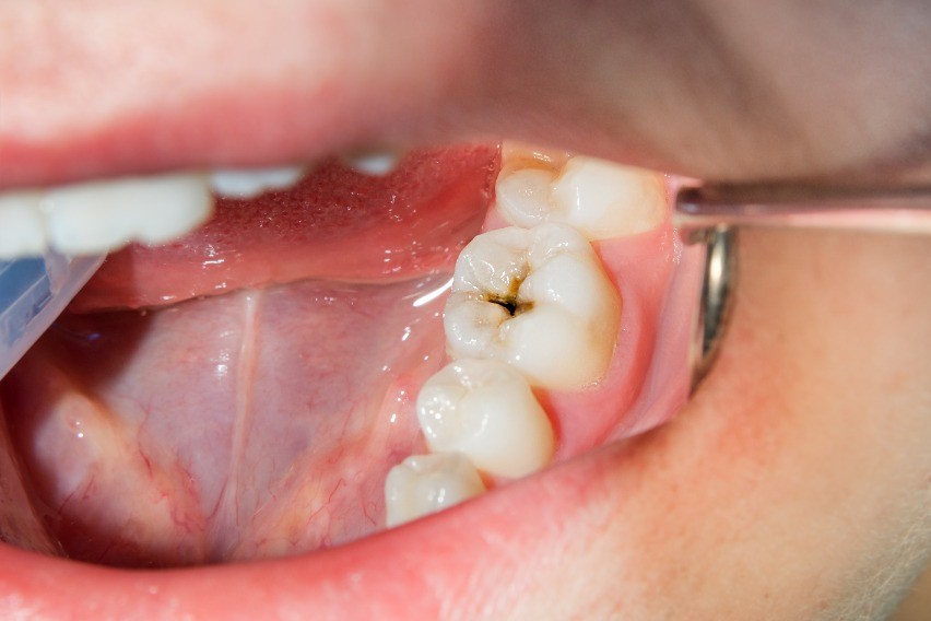 3 - پوسیدگی یا کرم خوردگی دندان چیست؟