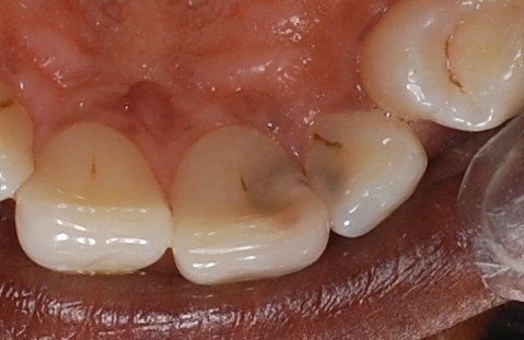 پوسیدگی یا کرم خوردگی دندان