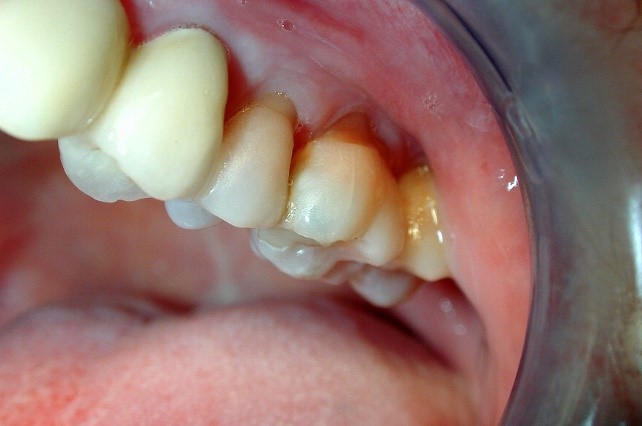 تحلیل دندان 