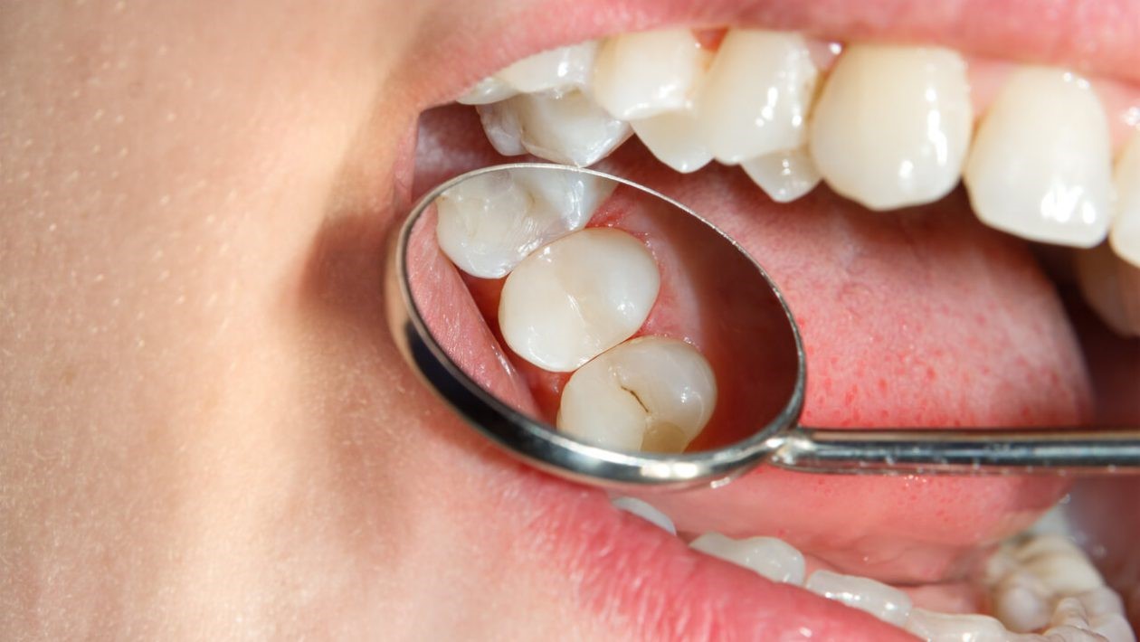 حساسیت دندان پس از پر کردن دندان