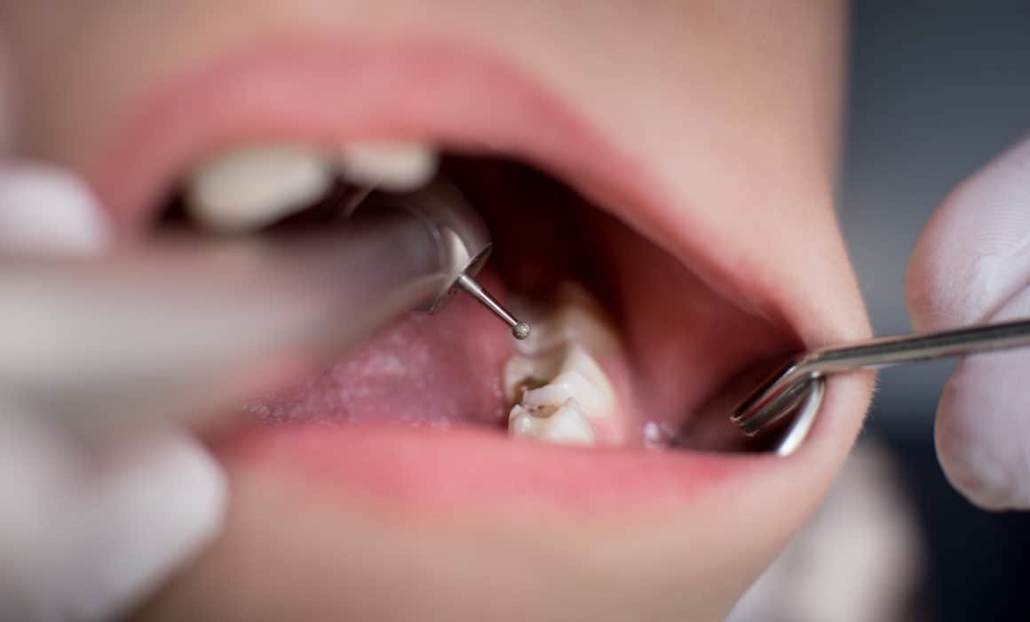 حساسیت دندان پس از پر کردن دندان