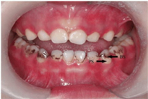 4 - جلوگیری از لک شدن دندان ها با مکمل آهن