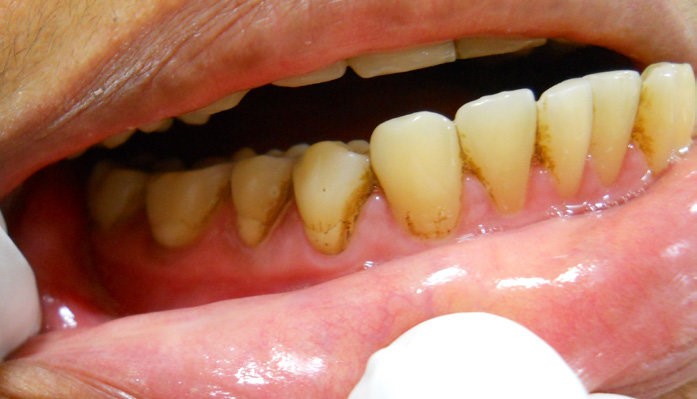 لک شدن دندان با مکمل آهن