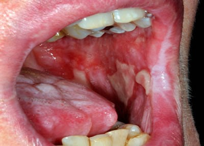 8 - زخم های دهانی: علل و درمان آنها
