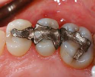 حساسیت به مواد دندانپزشکی