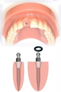 25 - مینی ایمپلنت های دندانی