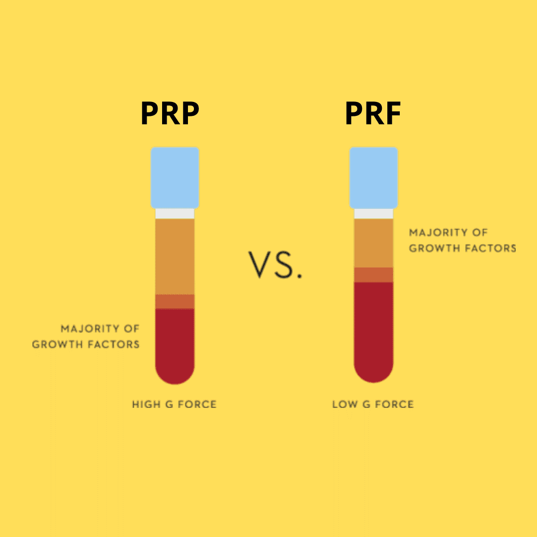 PRP یا PRF برای دندانپزشکی