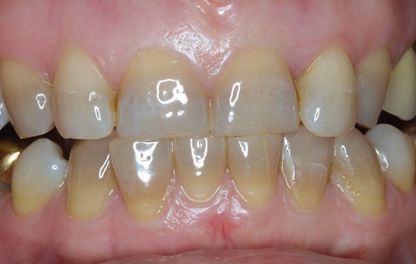 5 1 - لک شدن دندان ها با داروی تتراسایکلین