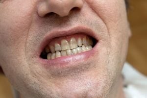 تتراسایکلین و تغییر رنگ دندان