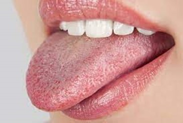 1 - علت تورم جوانه های چشایی یا پاپیلاهای روی زبان