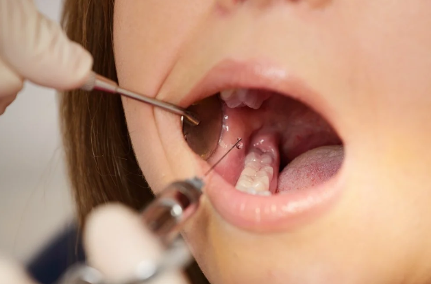 درمان بریدگی داخل دهان