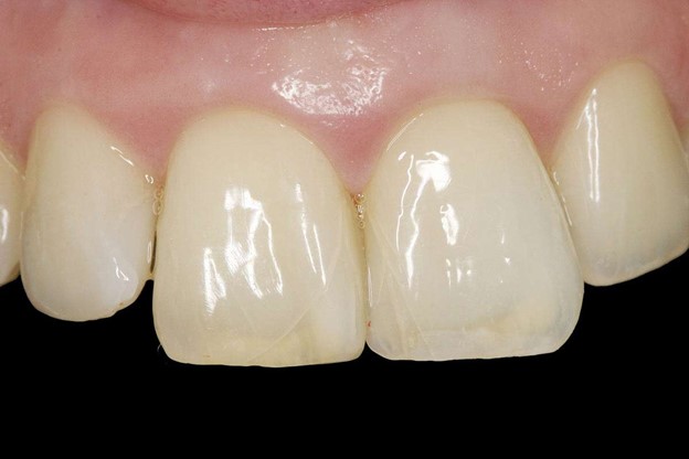 7 - آیا ترک های ریز و خطوط روی دندان ها نگران کننده هستند؟