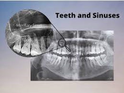 دندان درد سینوسی