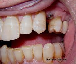 درد ایمپلنت دندانی