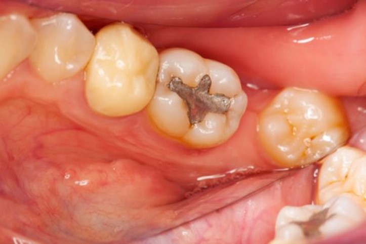 خارج شدن پر شدگی دندان 