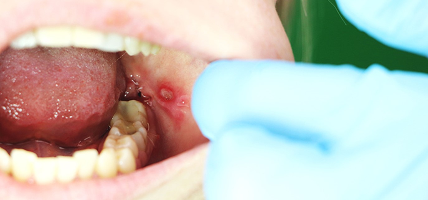 مضرات دندان قروچه 