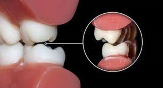 مضرات دندان قروچه 