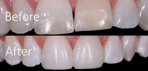 20 - کامپوزیت های دندانی: انواع و توصیه ها