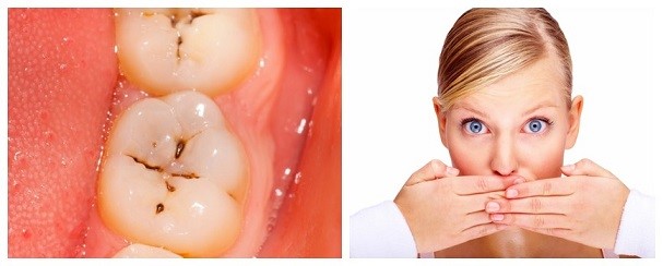 20 - ارتباط بوی بد دهان و پوسیدگی دندان ها