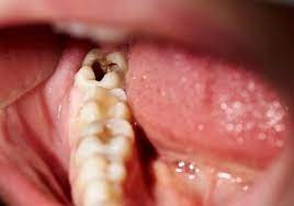 ارتباط بوی بد دهان و پوسیدگی دندان ها